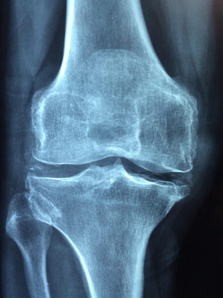 Arthritis & Joint Health