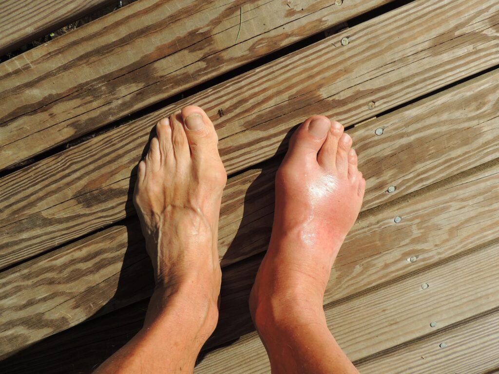 Gout
